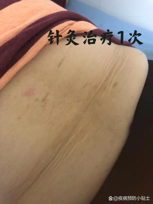 腰肌劳损针灸后更严重