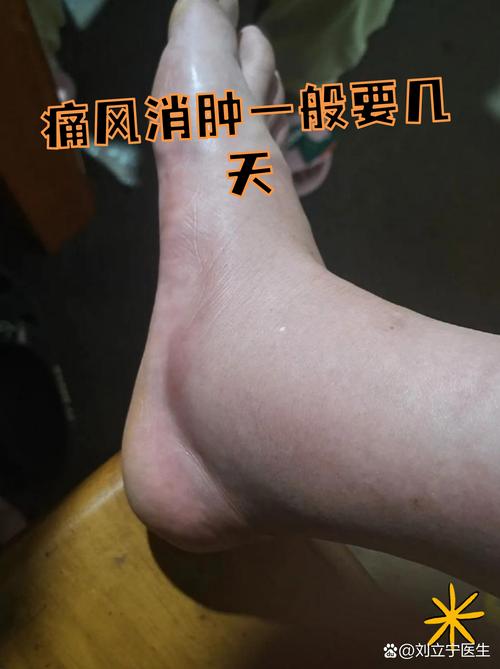 痛风发作一般几天会好