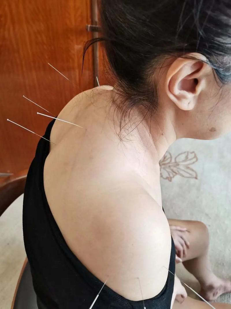 针灸治胃病多久才能好