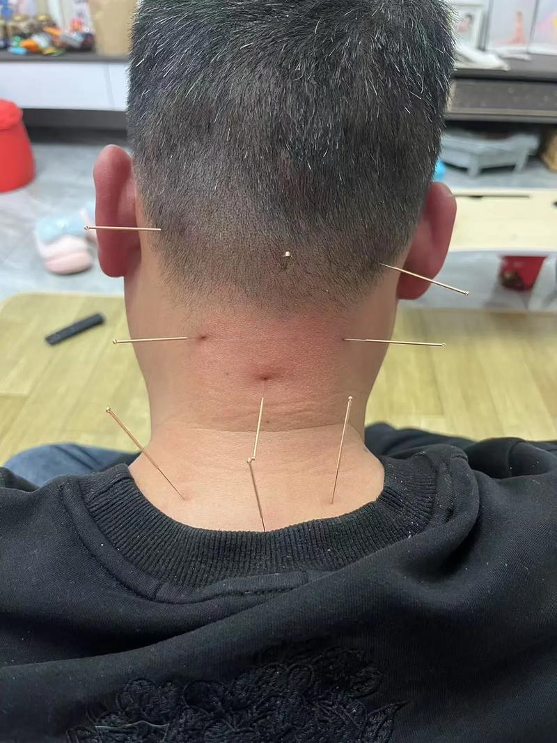 免费针灸算非法行医吗