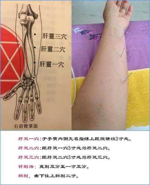 针灸治抑郁比中药有效