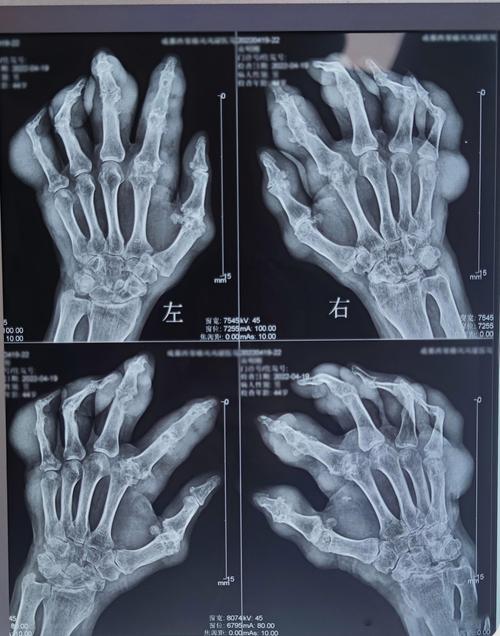 痛风怎么溶解尿酸结晶