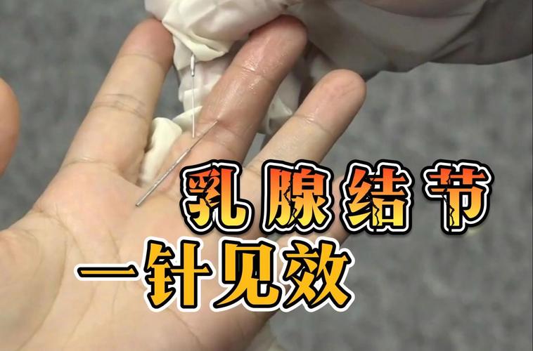 自己针灸治疗乳腺增生