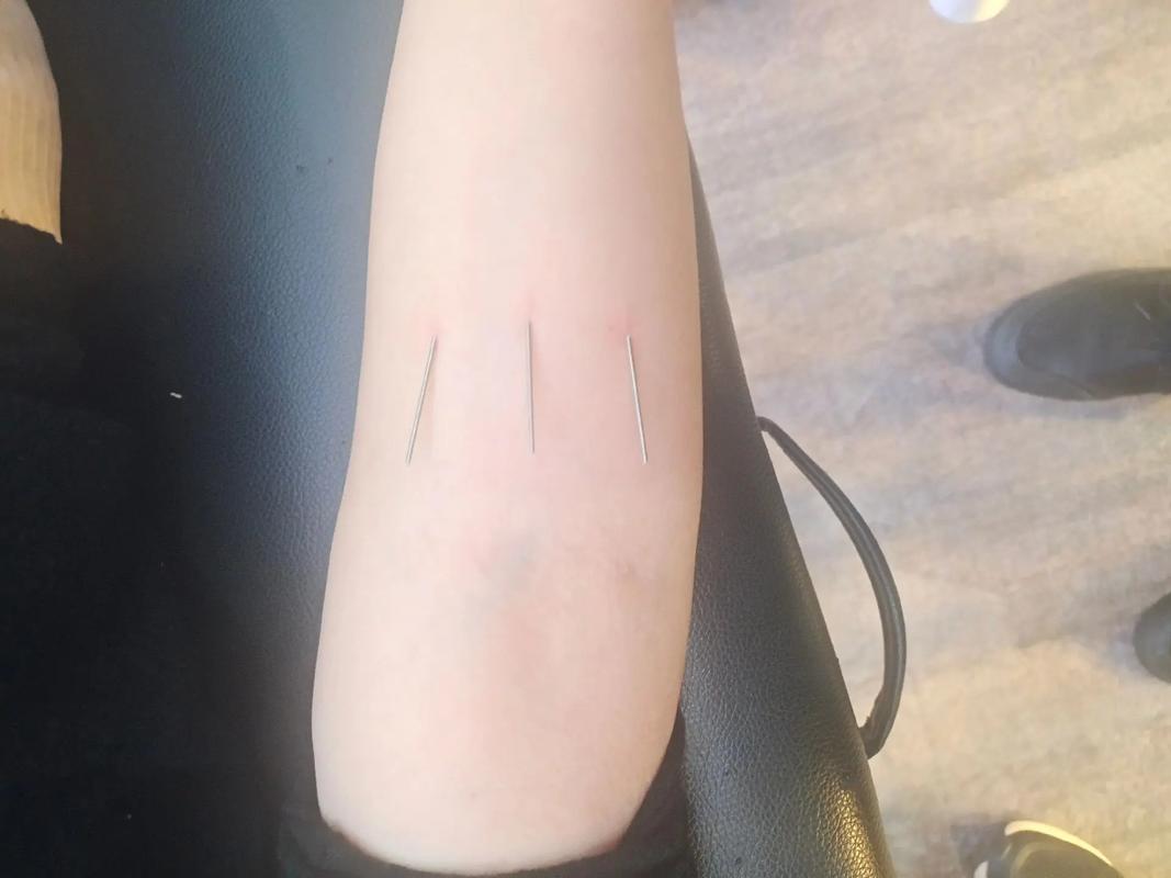 自己针灸治疗乳腺增生