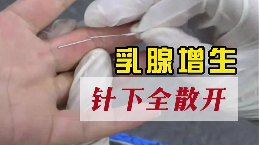 自己针灸治疗乳腺增生