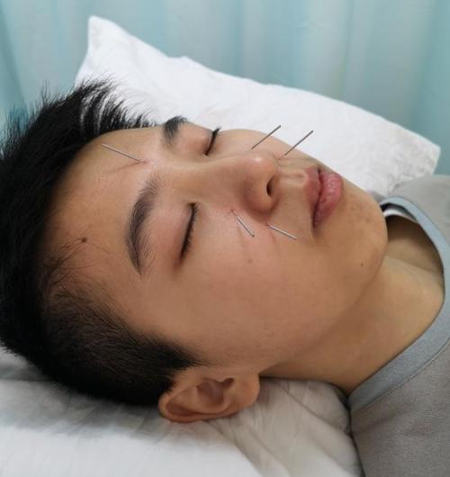 针灸几次能把鼻炎治好