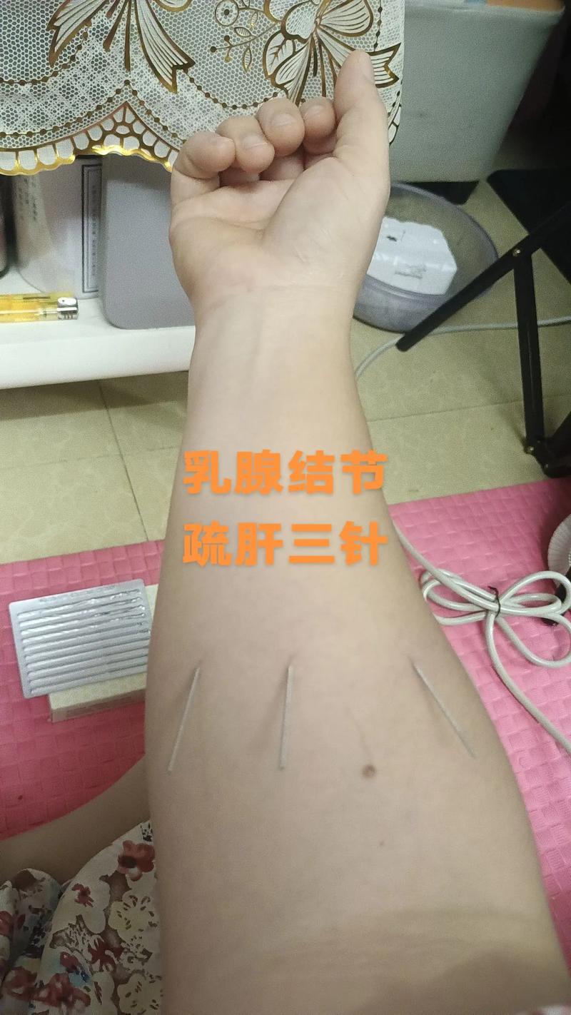 中年女性乳腺针灸视频