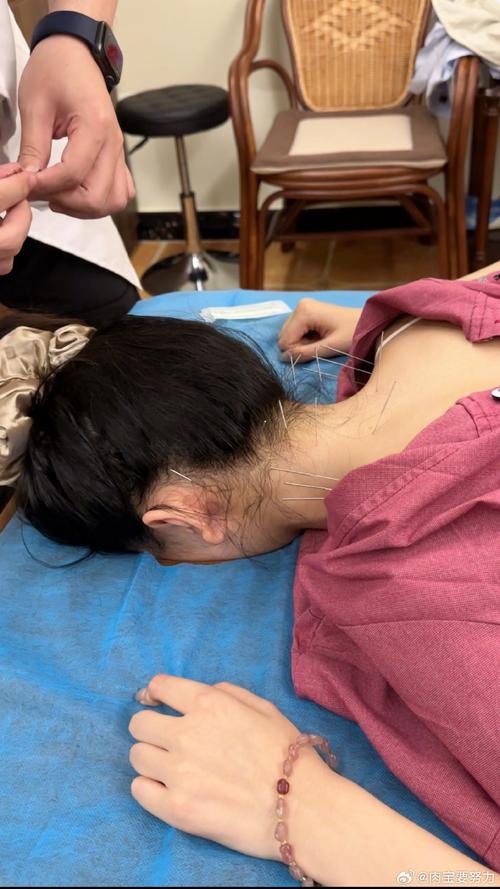 中年女性乳腺针灸视频