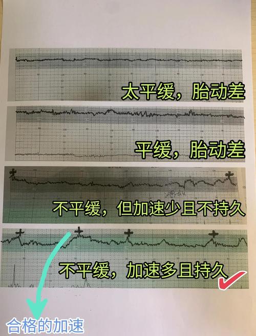 胎心正常是不是就安全
