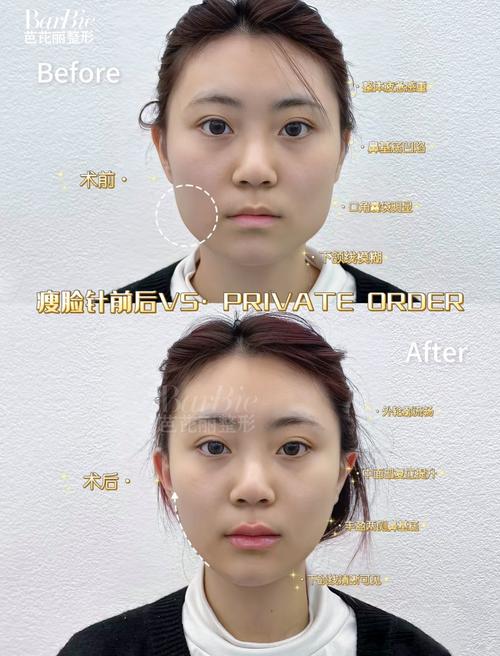 溶脂针安全还是瘦脸针