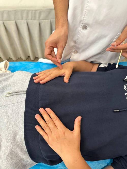 屁股针灸视频操作演示