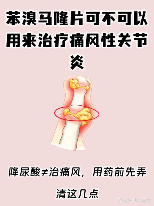 苯溴马隆是治痛风的吗