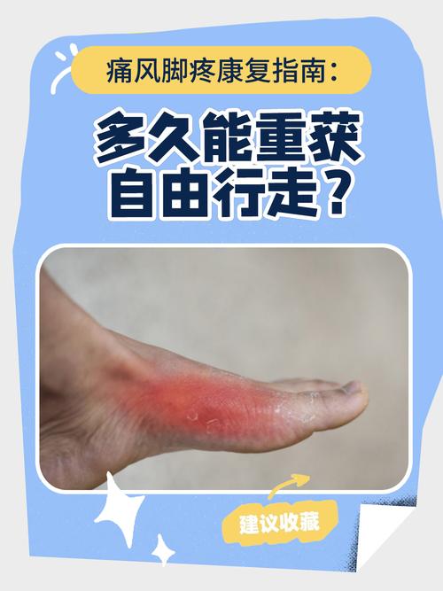 痛风一天什么时候最疼