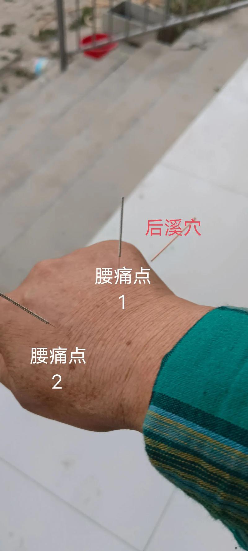 腰肌劳损治疗方法针灸