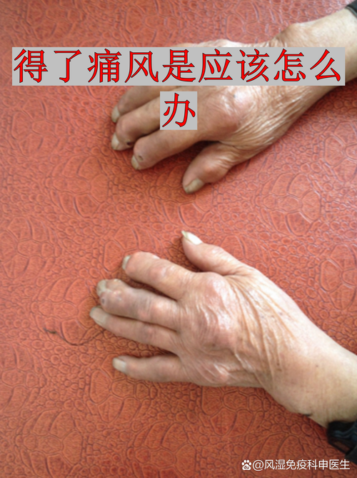 内风湿和痛风是一样吗