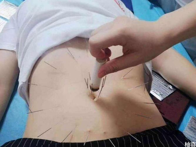 针灸治疗卵巢早衰效果