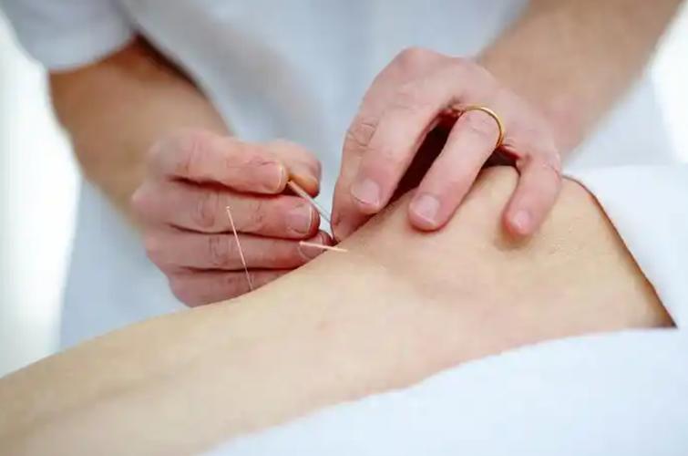 针灸治疗卵巢早衰效果