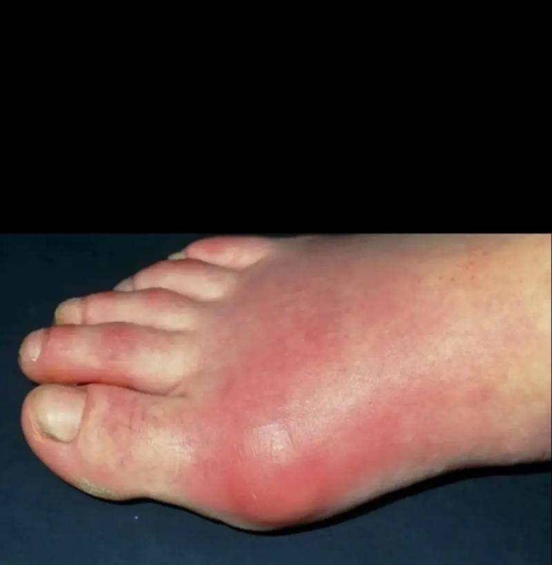 痛风一个多月了还没好