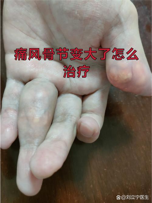 痛风性关节炎能痊愈吗