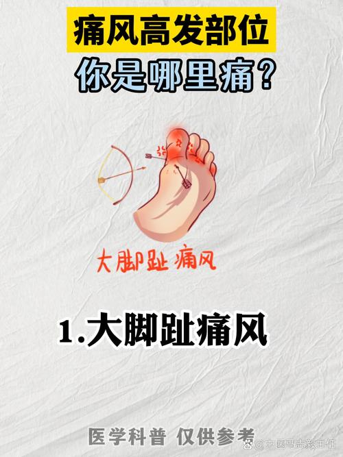 不动一点不疼是痛风吗