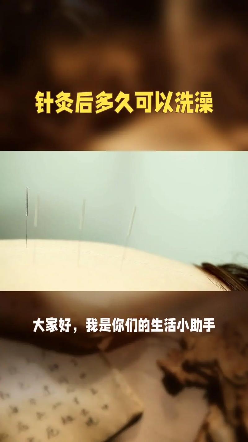 针灸过后多久可以洗澡