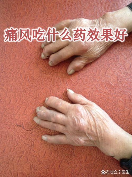 苯臭马龙治痛风怎么样