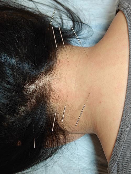 女性针灸视频最痛针灸