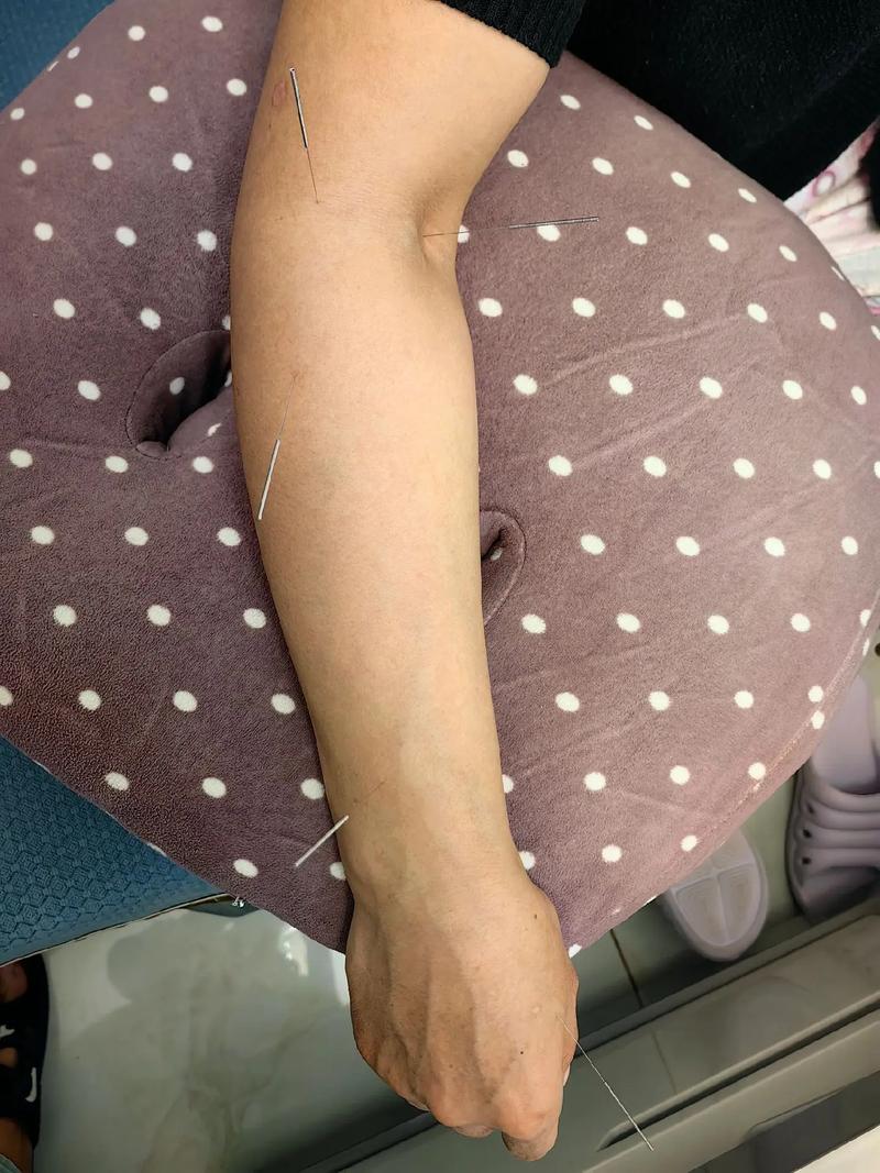 女性针灸视频最痛针灸