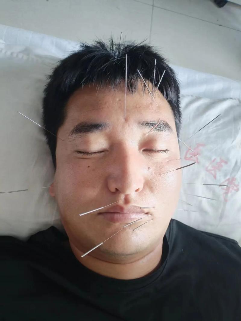 面瘫做针灸要针灸几天