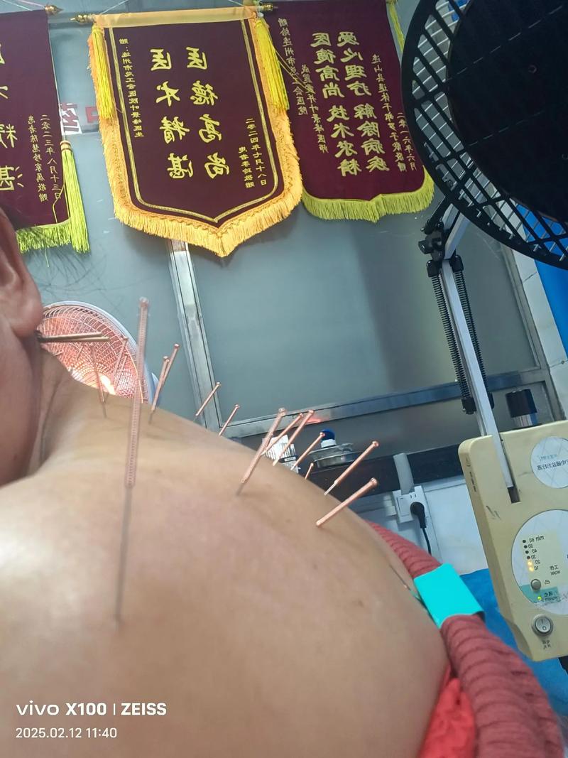 强直性脊柱炎针灸疗法