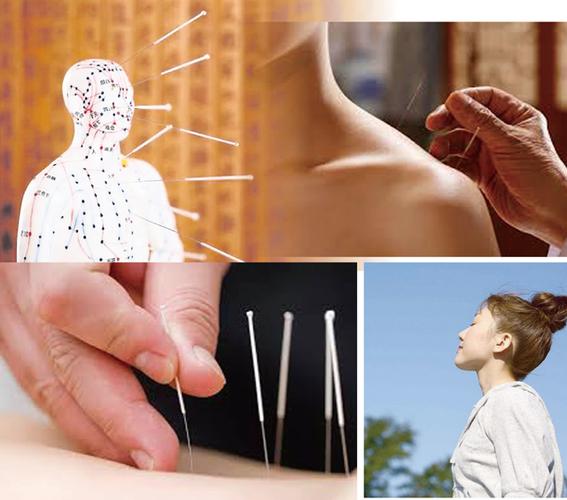 强直性脊柱炎针灸疗法