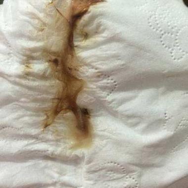 安全期也有褐色分泌物