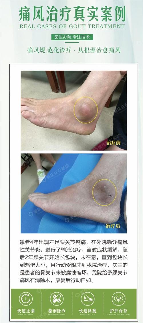 痛风石和腱鞘炎的区别