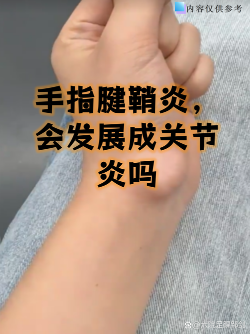 痛风石和腱鞘炎的区别