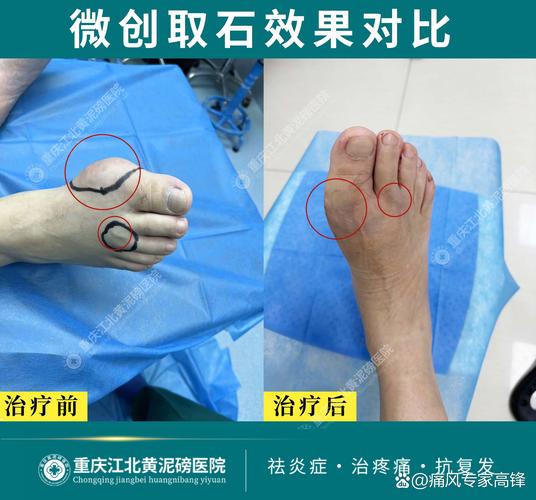 痛风石和腱鞘炎的区别