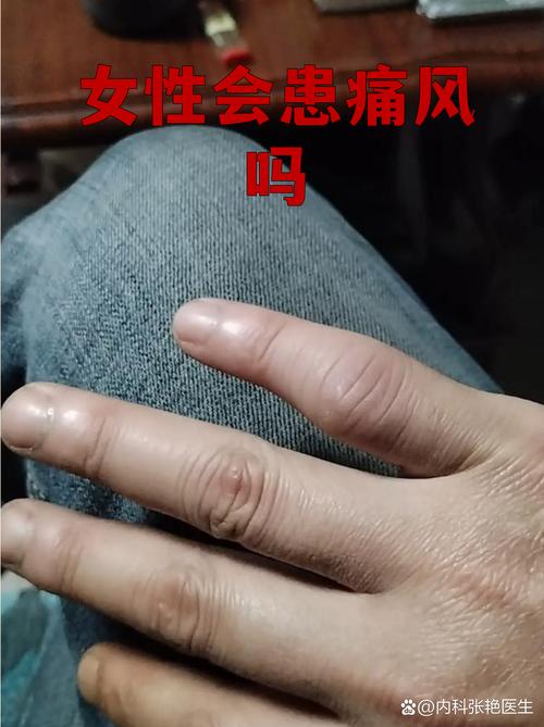 女的有没有得痛风的啊