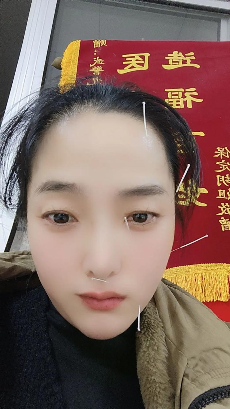 面瘫针灸三个月未恢复