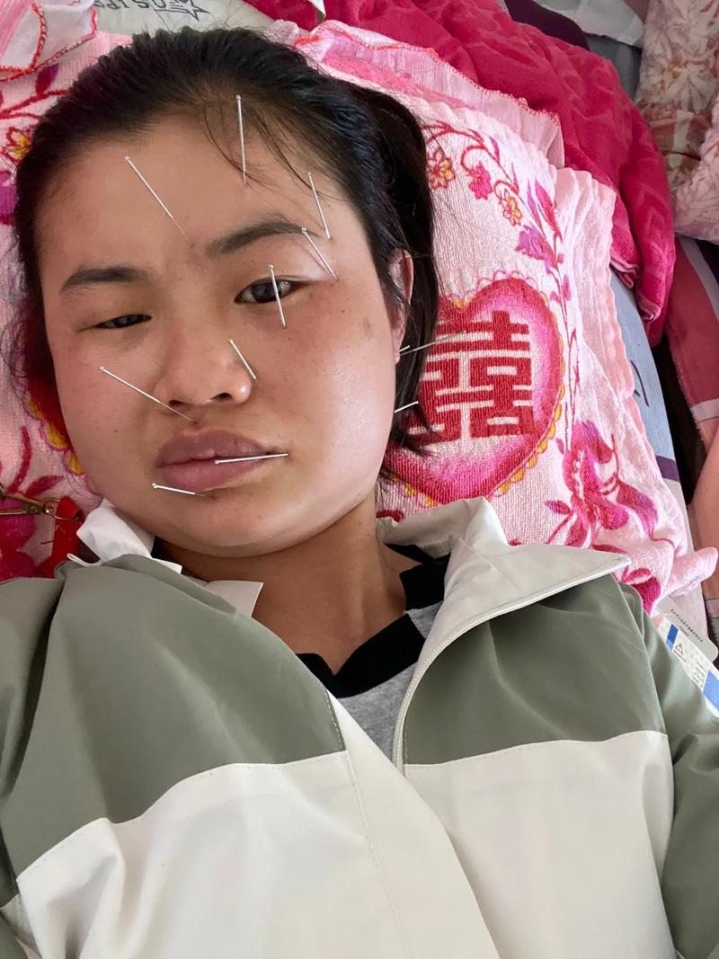 面瘫针灸三个月未恢复