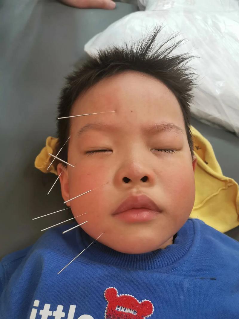 面瘫针灸三个月未恢复