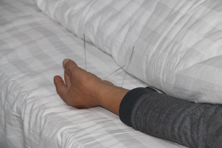 针灸能治内分泌失调吗