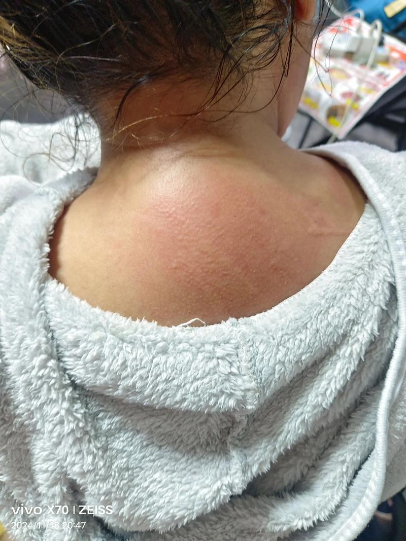 针灸后皮肤起包怎么办