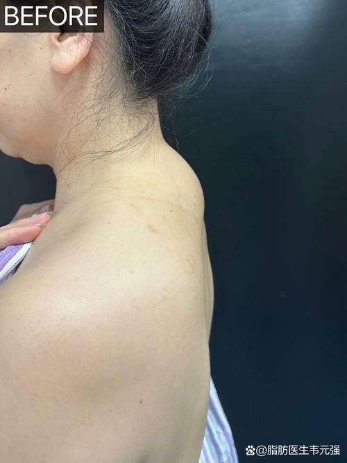 针灸后皮肤起包怎么办