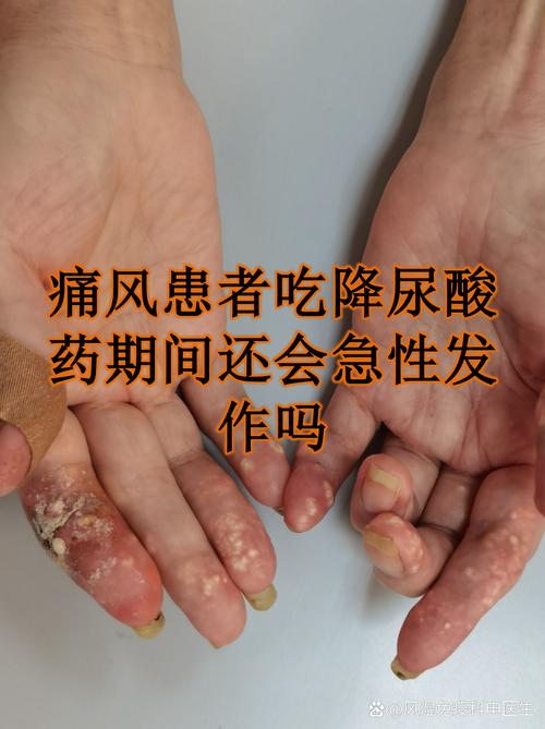 痛风药吃多了会怎么样