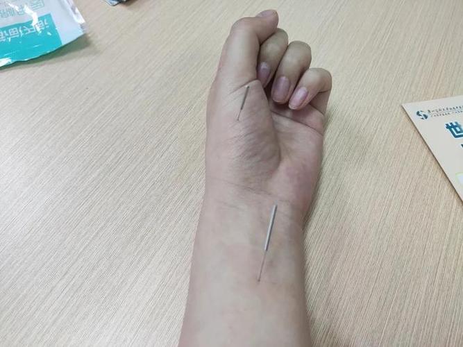 扎针灸反而睡不着觉了