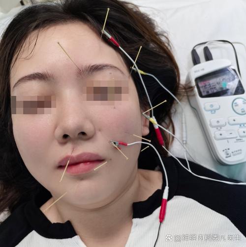 面瘫一周内可以针灸吗