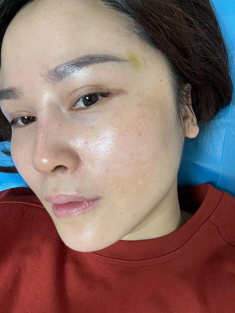 黄褐斑针灸治疗有用吗