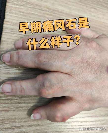 痛风和结石有什么关系