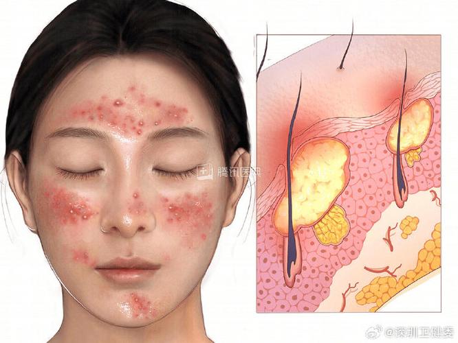 针灸后为什么脸上长痘