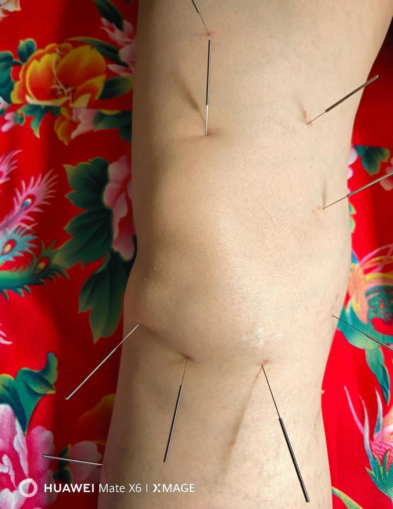 膝盖针灸后胀痛怎么办