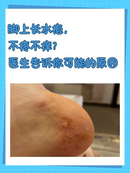 痛风可以烧姜水泡脚吗